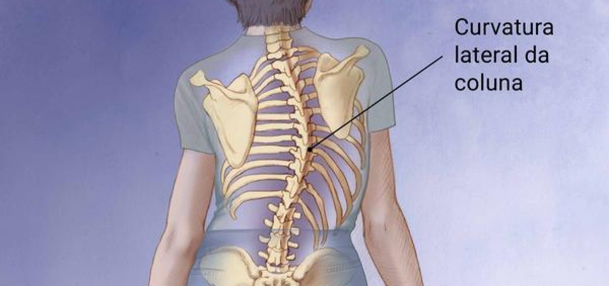 Médico explica: Escoliose, mais do que viver com a coluna aos 'ésses